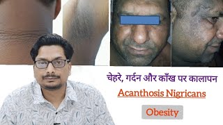 चेहरे गर्दन और काँख की skin का कालापन Face amp Neck pigmentation removal cream amp treatment Acanthosis [upl. by Atrim]