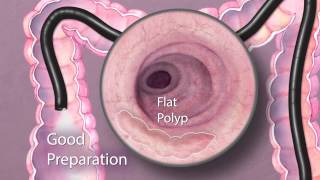 The Importance of Good Bowel Preparation During Colonoscopy [upl. by Bethina]