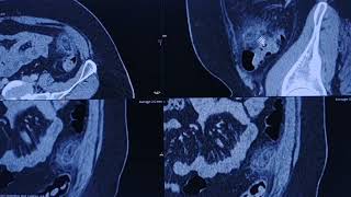 Epiploic appendagitis  CT findings [upl. by Eicarg]