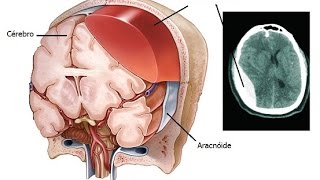 Subdural Hematoma [upl. by Ahsart254]