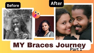 😨MY BRACES JOURNEY😳😱malayalam part 1 vazhakutti braces malayalam dentalcare [upl. by Aenat]