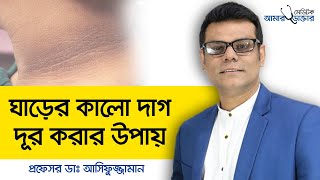 Dark Neck  Causes  Treatment  Home remedies  Dermatologist  ঘাড়ের কালো দাগ [upl. by Aslam]