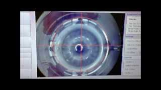 LASIK 100 laser with custom elliptical flap for astigmatism correction [upl. by Bradan]