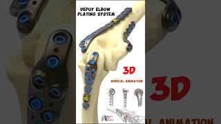 Depuy Elbow Plating System medical 3danimation short biology With Aliya [upl. by Derej579]