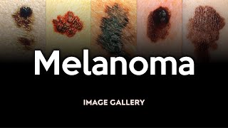 Melanoma Image Gallery [upl. by Fife]