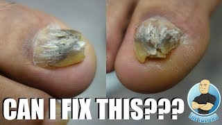 TRYING TO FIX A DAMAGED amp DEFORMED BIG TOENAIL [upl. by Peoples]