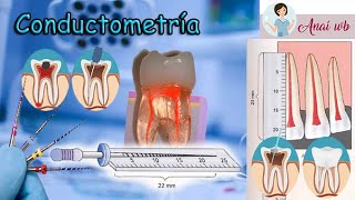 ENDODONCIA  Conductometría Técnica de Ingle [upl. by Niassuh]