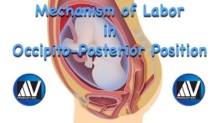 Mechanism of Labor in OccipitoPosterior Position [upl. by Alake]