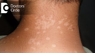 Pharmacological management of Tinea Versicolor in young individuals  Dr Urmila Nischal [upl. by Ahsa]