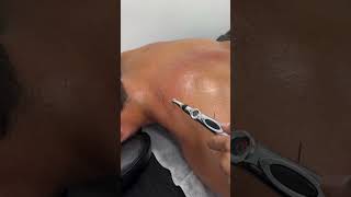 Upper Trap Needling with ElectroStimulationWho needs thisfyp explore physiotherapy [upl. by Shadow291]