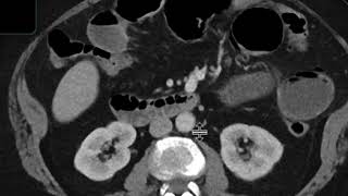 Gallstone ileus [upl. by Ofilia]