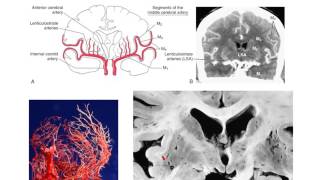 The lenticulostriate vessels and lacunar infarcts [upl. by Iahc]