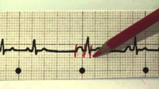 EKG für Pflege Teil 17  Supraventrikuläre Extrasystolen interpretieren SVES [upl. by Giamo]