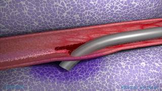 Peripheral IV Infiltration Animation [upl. by Jarv]