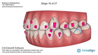 Treatment of highly placed canine with Invisalign aligners in India [upl. by Enaamuj694]