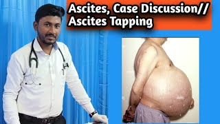 Ascites  Case Discussion Ascites Tapping Procedure [upl. by Appolonia]