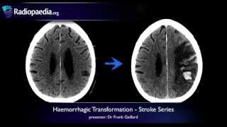 Stroke Haemorrhagic transformation  radiology video tutorial CT MRI [upl. by Islaen]