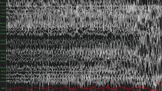 Interictal Discharges amp GTC Seizure [upl. by Yamauchi525]