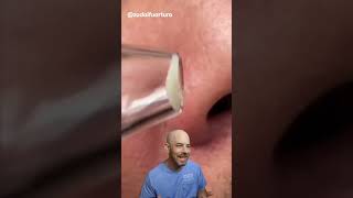 I wouldn’t recommend a pore vacuum 🛑 credit zudaifuarturo on TT doctor satisfying viral [upl. by Pirnot]