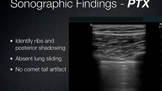 Lung Ultrasound EFFUSIONCONSOLIDATION [upl. by Debee]