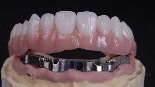 All on 4 implant bar supported denture [upl. by Eiramyma]