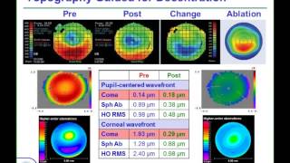 LoVC Course on Therapeutic Corneal Refractive Surgery Part 3 of 6 Decentration [upl. by Aiciram]