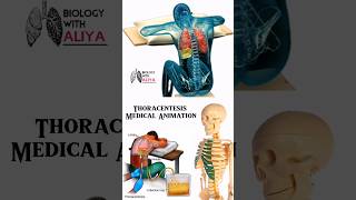 Thoracentesis Medical Animation  biology With Aliya medical animation 3d short [upl. by Ingemar]