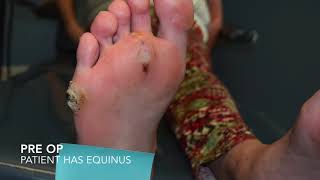 Wound Care The Role of Podiatrist [upl. by Danita42]