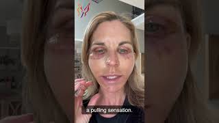 My Advanced Facelift Recovery Day by Day  Real Stories By Real Patients 2022 [upl. by Tahmosh909]