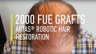 Hair transplant 2000 FUE Grafts ARTAS® Robotic Hair Restoration  Hair By Dr Max [upl. by Potash302]