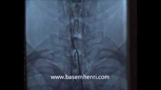 تسليك إلتصاقات القناة العصبية العنقية لعلاج الجراحات السابقة الفاشلة د باسم هنرى CX neuroplasty [upl. by Aynekal]