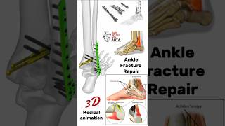 Orthopedics Ankle Fracture Repair animation 3d short  learn Biology with Aliya [upl. by Edelstein]