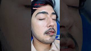 Carbon Peel Laser Treatment getsmarthairclub viralvideo beauty laserhairtreatment laser [upl. by Alyam908]