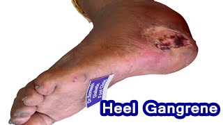 heel infection Diabetic Gangrene Healing by podiatist chennai [upl. by Giraud]