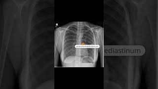 Pneumomediastinum and subcutaneous emphysema [upl. by Niccolo]