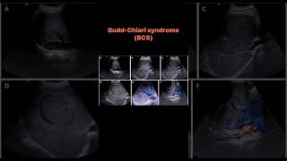 BuddChiari syndrome BCS [upl. by Atteuqahc]