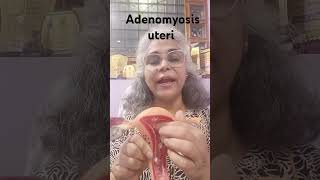 Adenomyosis of uterus health इनफॉर्मेशन [upl. by Fennell]