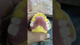 Upper Removable Partial Denture Ready for Flasking 😁😁😁 [upl. by Cony889]