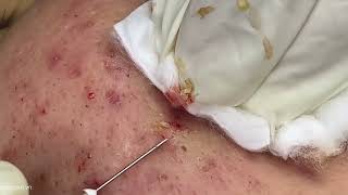 Big Cystic Acne Blackheads Extraction Blackheads amp Milia Whiteheads Removal Pimple Popping [upl. by Caterina497]