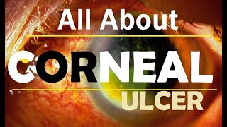 Corneal Ulcer Bengali [upl. by Olraced887]