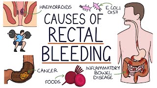 Understanding the Causes of Blood in Stool Rectal Bleeding [upl. by Haneekas]