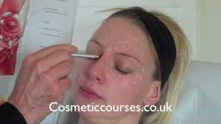 Botox training 2 Where to place Botox injections [upl. by Nairot]