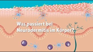 Was passiert bei Neurodermitis im Körper [upl. by Obnukotalo428]