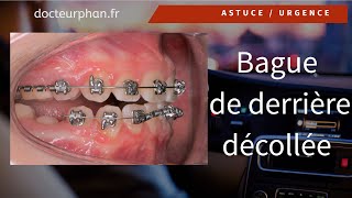 Tuto appareil dentaireorthodontique que faire quand une bague du fond se décolle [upl. by Lehcear]