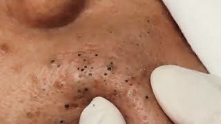 Satisfying Blackhead Removal [upl. by Evania]