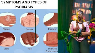 SYMPTOMS AND TYPES OF PSORIASIS [upl. by Majka]