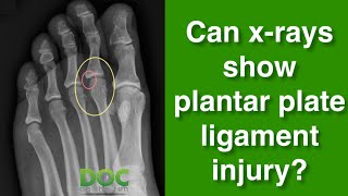 Can xrays show a plantar plate injury [upl. by Sorac]