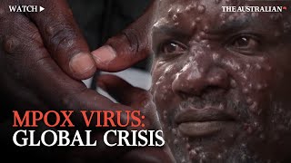 Mpox Outbreak Understanding the global health emergency [upl. by Radbourne]