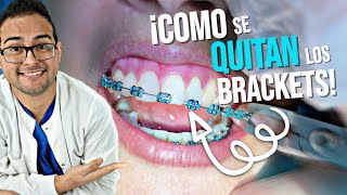 COMO se QUITAN los BRACKETS 👄 y se PONEN los RETENEDORES 🔥 RETIRO de ORTODONCIA  BRACES OFF 2019 [upl. by Aissila]