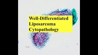 Lipomatous Tumor Cytopathology Interesting Case Conference [upl. by Terrence398]